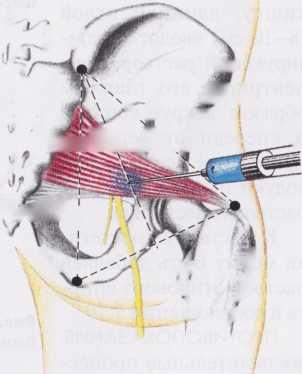 БЛОКАДА ГРУШЕВИДНОЙ МЫШЦЫ БЛОКАДА ГРУШЕВИДНОЙ МЫШЦЫ
